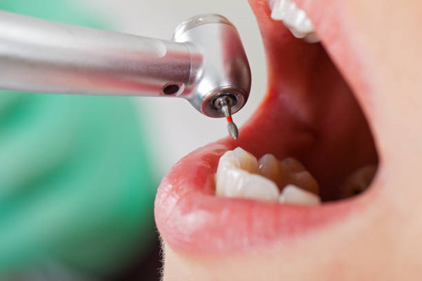 Best Dental Abscess Treatment in Oskaloosa, KS